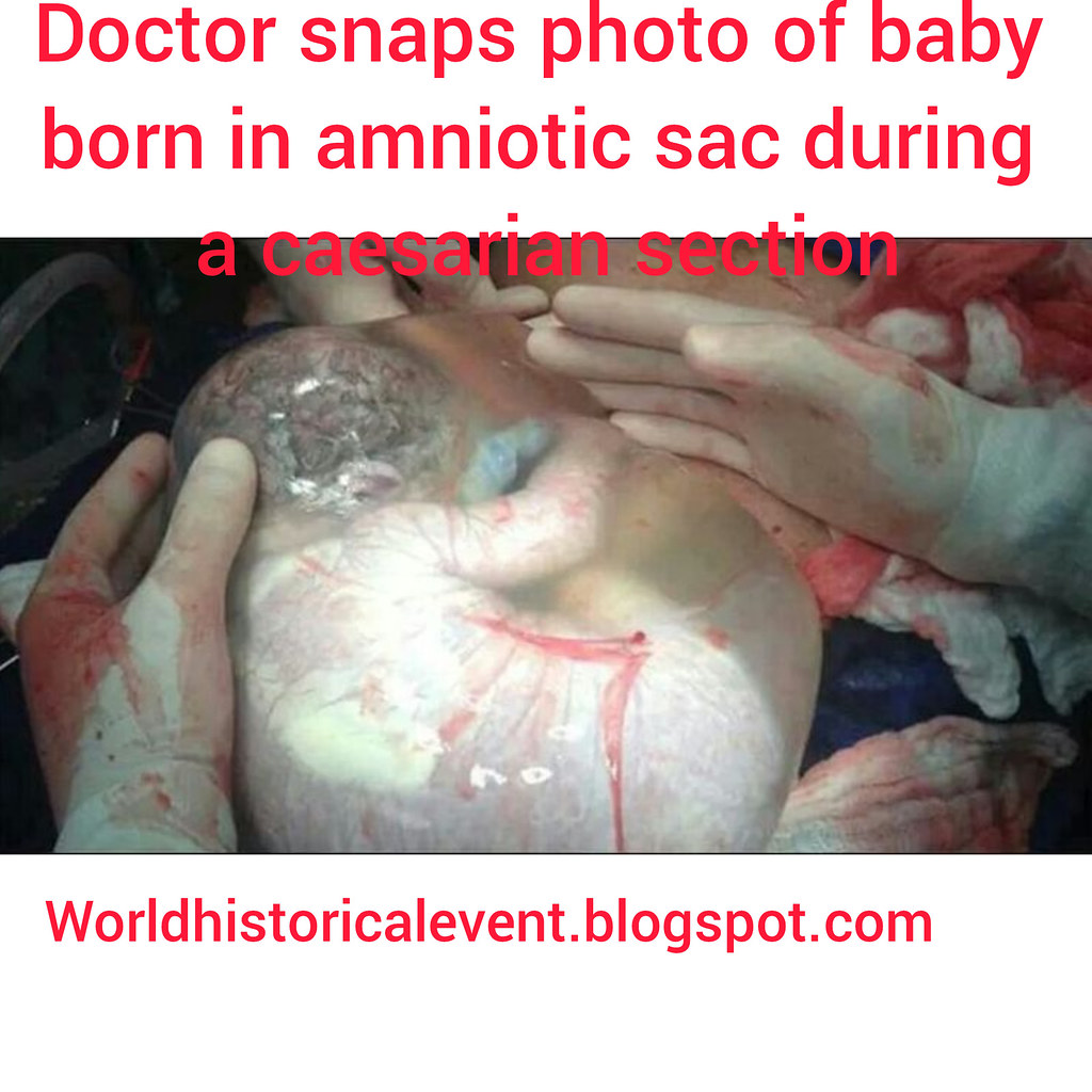 Doctor snaps photo of baby born in amniotic sac during a caesarian section — related to Regenerative medicine doctor